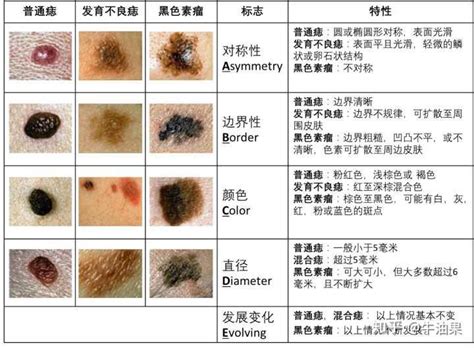 臉部 痣|痣是什麼？會變成黑色素瘤？7種一定要除的痣